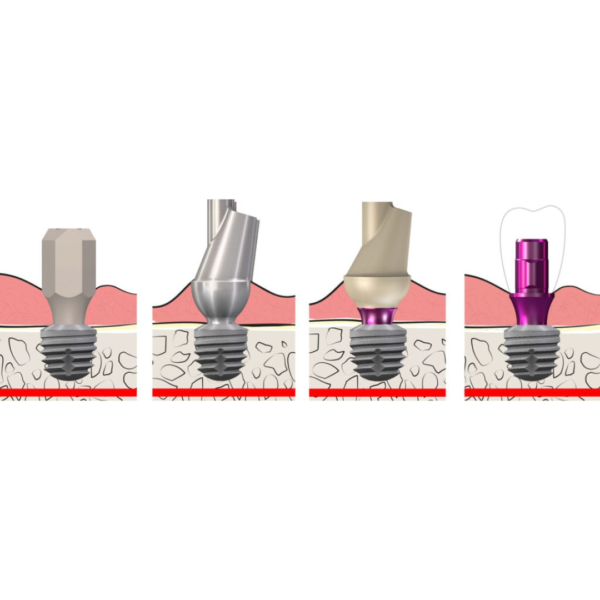 copaSKY CAD/CAM restorations