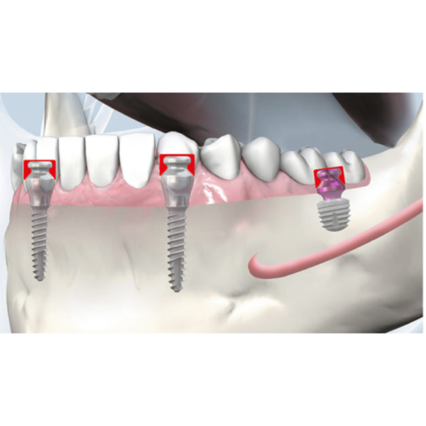 copaSKY TiSi.snap prosthesis fixation