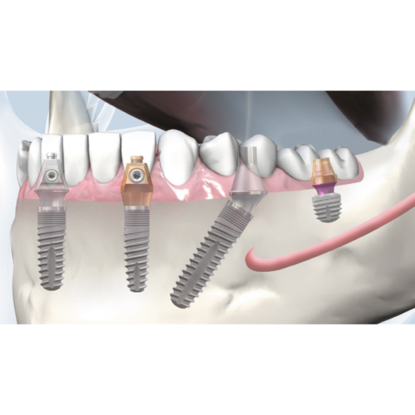 copaSKY uni.cone abutment