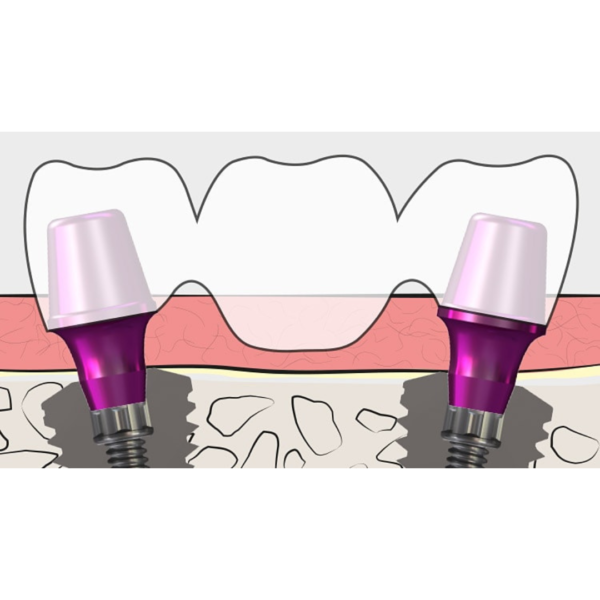 copaSKY abutment for bridges and bars