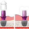 copaSKY CAD/CAM restorations - Image 2