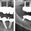 copaSKY uni.cone abutment - Image 2