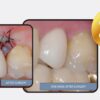 SKY fast & fixed and screw retained bridge abutment - Image 3